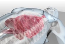 英厄姆研究所MRI-Linac 动画介绍-器械之心